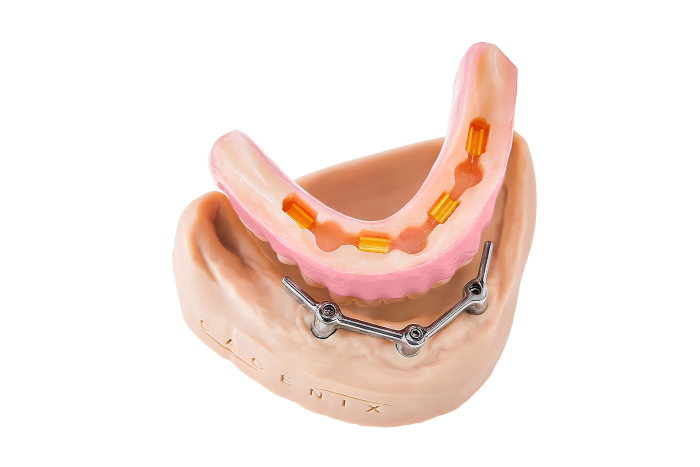 AccuFrame Overdenture 7
